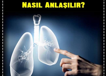 Akciğer Kanserinin İlk Belirtileri Nelerdir, Nasıl Anlaşılır? 2