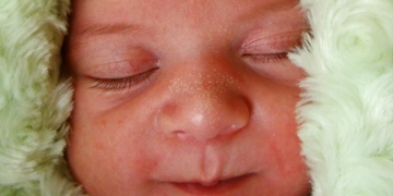 bebeklerde beyaz nokta neden cikar bebeklerde akne nedenleri k6ykiefg.jpg