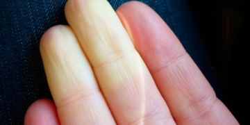 beyaz parmak hastaligi raynaud sendromu nedir raynaud reyno sendromu belirtileri nelerdir gax61rwz.jpg